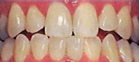 whitening;  Team Leatherman Care Dentistry, Lorain, OH 44053